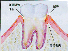 邊緣性齦炎 邊緣性齦炎
