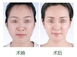 面頰填充 面頰填充