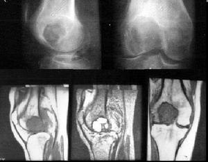 骨良性纖維組織細胞瘤 骨良性纖維組織細胞瘤