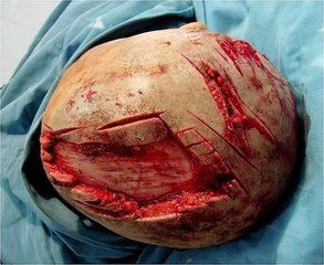 顱骨缺損 顱骨缺損