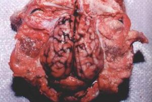 顱內非特異性感染