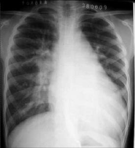 先天性心臟血管病