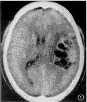 頭部平掃 頭部平掃