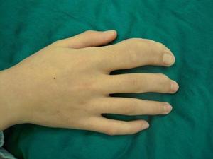 肢體增長增粗過度 肢體增長增粗過度