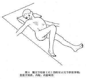 （圖）髖關節結核病