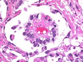 卵巢卵黃囊瘤 卵巢卵黃囊瘤