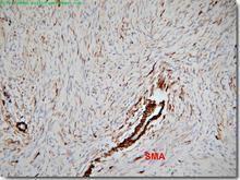 乳腺結節病 乳腺結節病