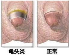 龜頭炎