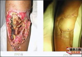 急性血源性骨髓炎