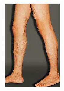 單純性下肢靜脈曲張