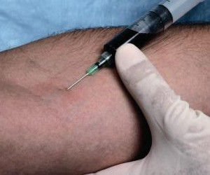 靜脈穿刺 靜脈穿刺