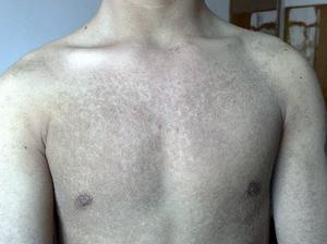 先天性魚鱗病 先天性魚鱗病