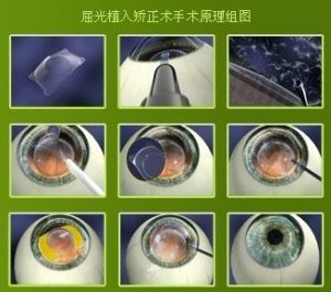 高度近視手術 高度近視手術