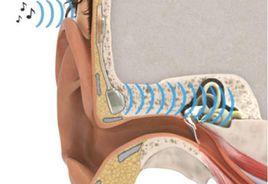 植入式助聽器 植入式助聽器