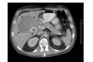 Mirizzi綜合徵 Mirizzi綜合徵
