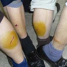 狂犬病暴露 狂犬病暴露