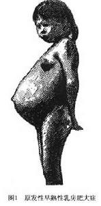 早熟性兒童乳房肥大症