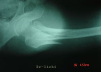 股骨粗隆間骨折