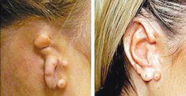 耳再造 耳再造
