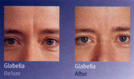 眉間豎紋 眉間豎紋