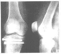 （圖）脛骨平台骨折
