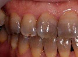 牙齒黑斑 牙齒黑斑