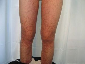 繼發性血小板增多症 繼發性血小板增多症