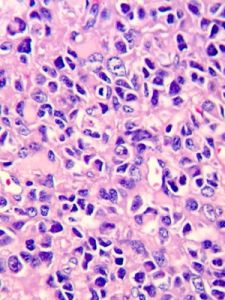 星形細胞瘤 星形細胞瘤