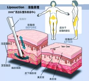 分層活化溶脂 分層活化溶脂
