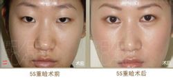 5S重瞼術 5S重瞼術