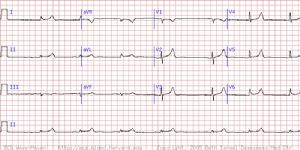 高鉀血症 心電圖