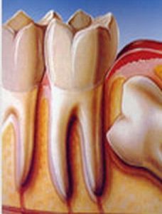 智齒冠周炎 智齒冠周炎