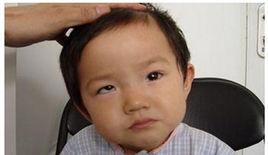 眼睛內斜 眼睛內斜