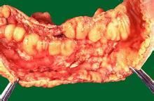小腸克隆氏病 小腸克隆氏病