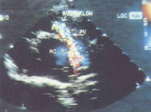 鎖骨下動脈盜血綜合徵