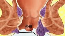 肛腸病外痔病 肛腸病外痔病