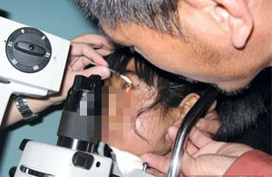 獲得性視網膜劈裂