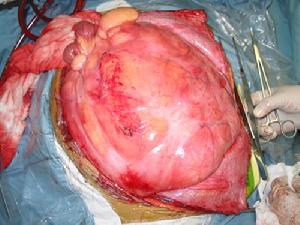 （圖）脂肪肉瘤