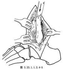 脛距跟融合術 脛距跟融合術