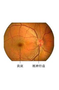 黃斑變性