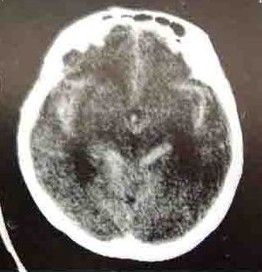 自發性蛛網膜下腔出血 自發性蛛網膜下腔出血