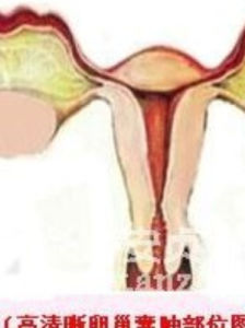 卵巢腫瘤 卵巢腫瘤