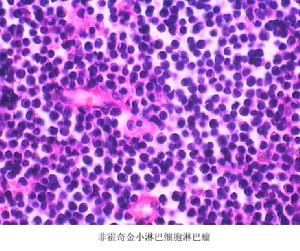 淋巴瘤細胞白血病