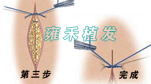 （圖）FUT顯微植髮技術