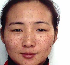 遺傳性雀斑 遺傳性雀斑