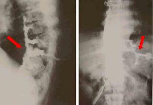 遺傳性痙攣性截癱