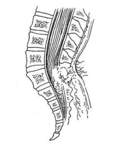 脊髓脊膜膨出 脊髓脊膜膨出