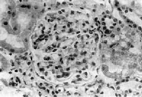 薄腎小球基底膜病