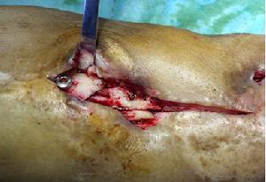 （圖）術中見骨壞死