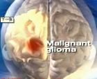 腦角質瘤 腦角質瘤